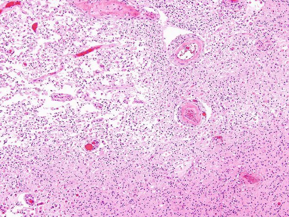 3B5 Cerebroretinal Vasculopathy (CRV, TREX, HERNS, Case 3) N16 H&E 4