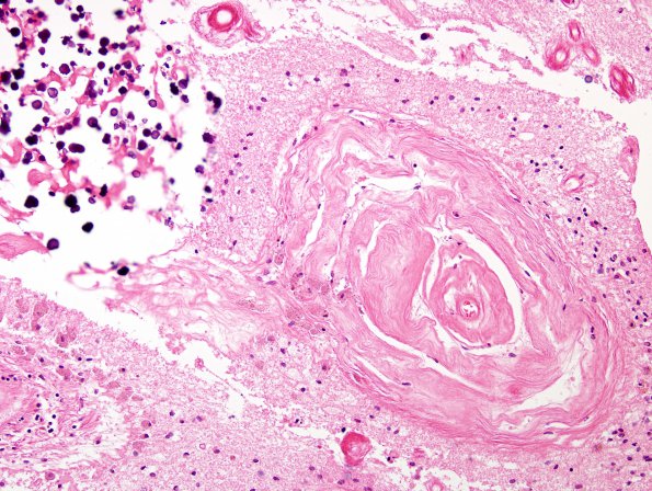 3B6 Cerebroretinal Vasculopathy (CRV, TREX, HERNS, Case 3) H&E 8