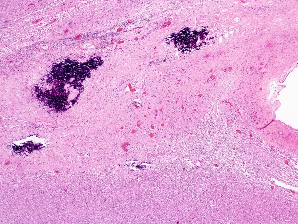 3C1  Cerebroretinal Vasculopathy (CRV, TREX, HERNS, Case 3) N19 H&E 1