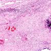 3C2 Cerebroretinal Vasculopathy (CRV, TREX, HERNS, Case 3) N17 H&E 2