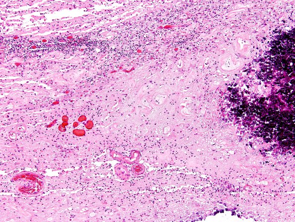 3C2 Cerebroretinal Vasculopathy (CRV, TREX, HERNS, Case 3) N17 H&E 2