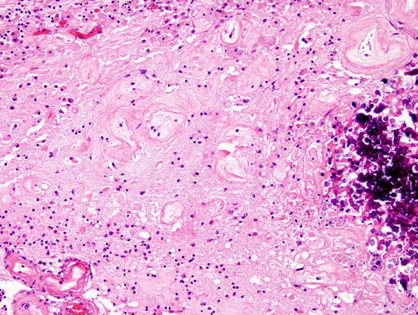 3C3 Cerebroretinal Vasculopathy (CRV, TREX, HERNS, Case 3) N17 H&E 1