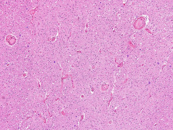 3C4 Cerebroretinal Vasculopathy (CRV, TREX, HERNS, Case 3) H&E 7B