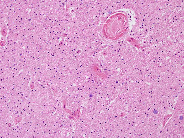 3C5 Cerebroretinal Vasculopathy (CRV, TREX, HERNS, Case 3) H&E 7A