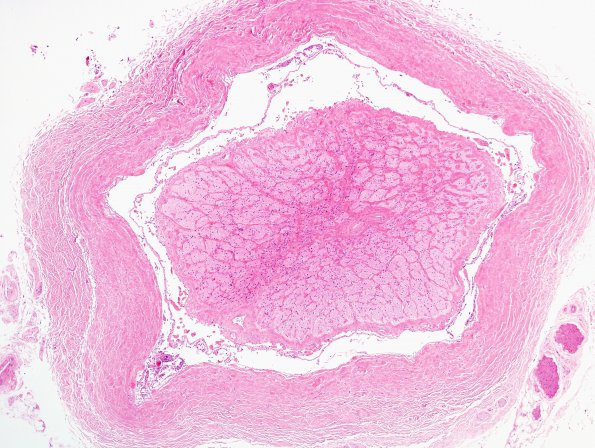 3D1 Cerebroretinal Vasculopathy (CRV, TREX, HERNS,Case 3) Left optic nerve 4X