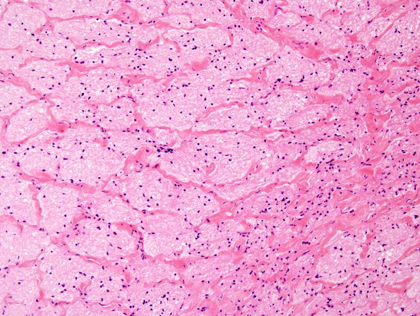 3D2 Cerebroretinal Vasculopathy (CRV, TREX, HERNS, Case 3) Left optic nerve 20X