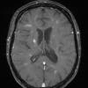 4A1 Cerebroretinal vasculopathy, CRV, RVCL, TREX, HERNS, Case 4 T1W 2 (2011) - Copy