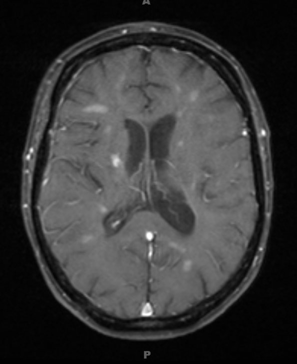 4A1 Cerebroretinal vasculopathy, CRV, RVCL, TREX, HERNS, Case 4 T1W 2 (2011) - Copy