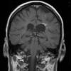 4B Cerebroretinal vasculopathy, CRV, RVCL, TREX, HERNS, Case 4 T1W 2 (2012) - Copy