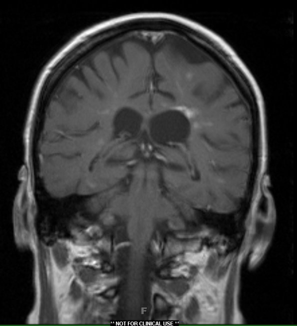 4B Cerebroretinal vasculopathy, CRV, RVCL, TREX, HERNS, Case 4 T1W 2 (2012) - Copy