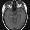 4C1 Cerebroretinal vasculopathy, CRV, RVCL, TREX, HERNS, Case 4 T1 (2013) copy - Copy