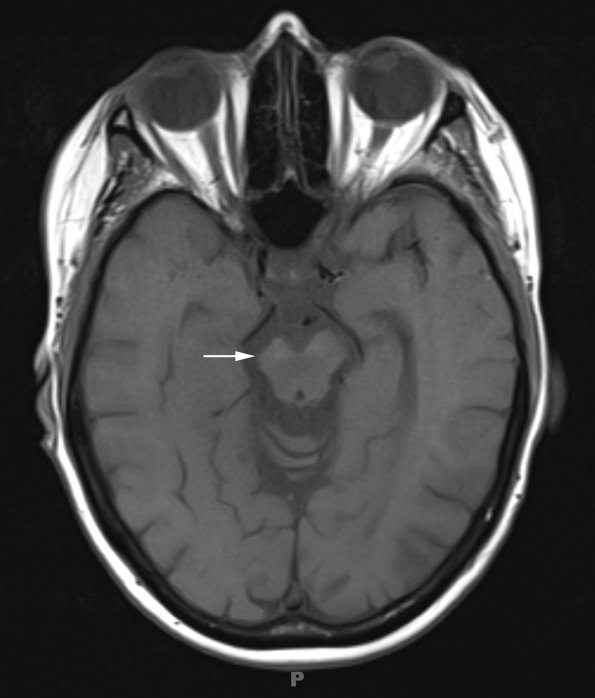 4C1 Cerebroretinal vasculopathy, CRV, RVCL, TREX, HERNS, Case 4 T1 (2013) copy - Copy