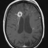 4C2 Cerebroretinal vasculopathy, CRV, RVCL, TREX, HERNS, Case 4 T1W (2013) - Copy