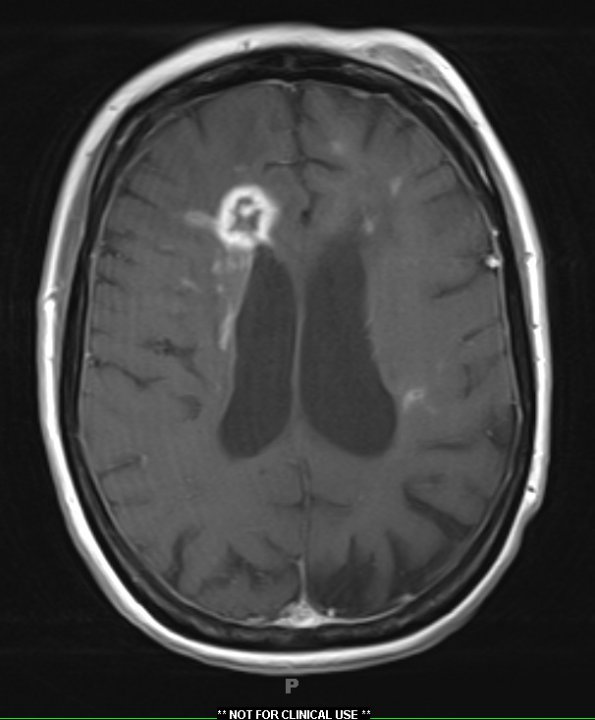 4C2 Cerebroretinal vasculopathy, CRV, RVCL, TREX, HERNS, Case 4 T1W (2013) - Copy