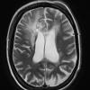 4C3 Cerebroretinal vasculopathy, CRV, RVCL, TREX, HERNS, Case 4 T2W 1 (2013) - Copy