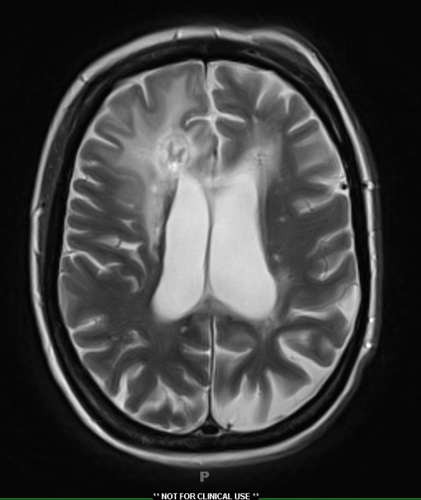 4C3 Cerebroretinal vasculopathy, CRV, RVCL, TREX, HERNS, Case 4 T2W 1 (2013) - Copy