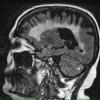 4D1 Cerebroretinal vasculopathy, CRV, RVCL, TREX, HERNS, Case 4 FLAIR 1 (2014 late) - Copy