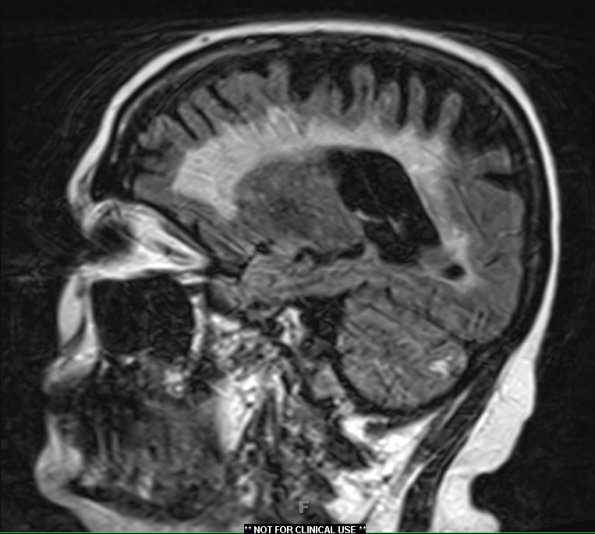 4D1 Cerebroretinal vasculopathy, CRV, RVCL, TREX, HERNS, Case 4 FLAIR 1 (2014 late) - Copy