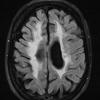 4D2 Cerebroretinal vasculopathy, CRV, RVCL, TREX, HERNS, Case 4 FLAIR 2 (2014 late) - Copy