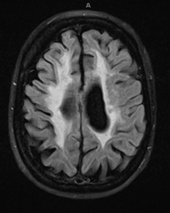 4D2 Cerebroretinal vasculopathy, CRV, RVCL, TREX, HERNS, Case 4 FLAIR 2 (2014 late) - Copy