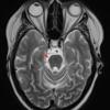 4D3 Cerebroretinal vasculopathy, CRV, RVCL, TREX, HERNS, Case 4 T2 1 (2014 late) copy - Copy