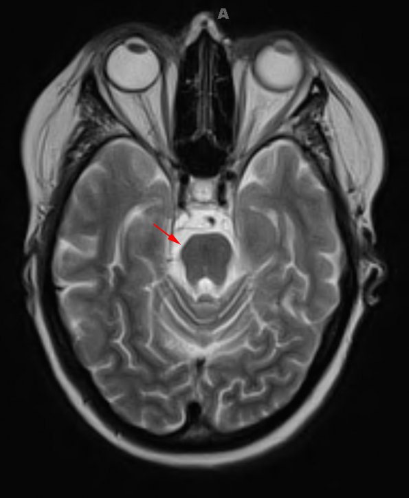 4D3 Cerebroretinal vasculopathy, CRV, RVCL, TREX, HERNS, Case 4 T2 1 (2014 late) copy - Copy