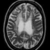 4D4 Cerebroretinal vasculopathy, CRV, RVCL, TREX, HERNS, Case 4 T2W 1 (2014) - Copy