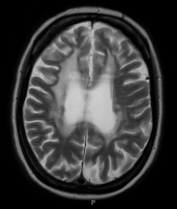 4D4 Cerebroretinal vasculopathy, CRV, RVCL, TREX, HERNS, Case 4 T2W 1 (2014) - Copy