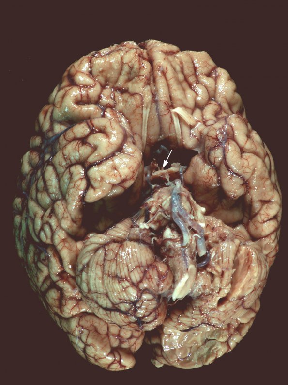 4E1 Cerebroretinal Vasculopathy, CRV, RVCL, TREX, HERNS, Case 4)_1 copy