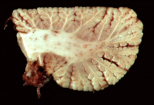 4E10 Cerebroretinal Vasculopathy, CRV, RVCL, TREX, HERNS, Case 4)_22