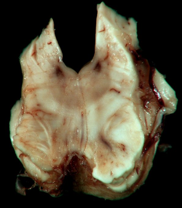 4E11 Cerebroretinal Vasculopathy, CRV, RVCL, TREX, HERNS, Case 4)_25