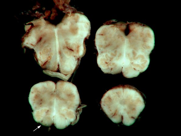 4E13 Cerebroretinal Vasculopathy, CRV, RVCL, TREX, HERNS, Case 4)_29 copy