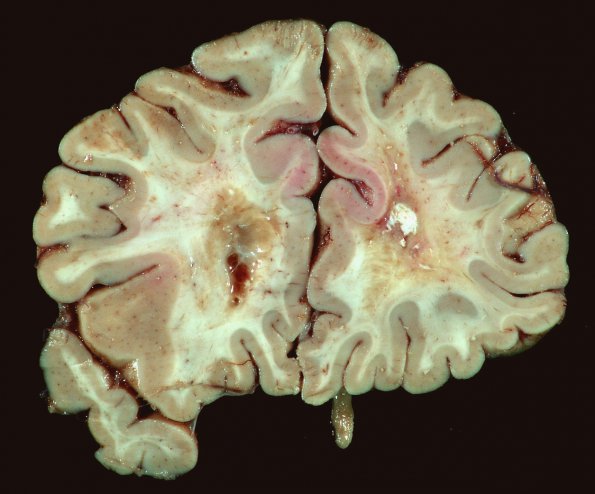 4E4 Cerebroretinal Vasculopathy, CRV, RVCL, TREX, HERNS, Case 4)_8