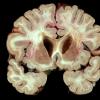 4E6 Cerebroretinal Vasculopathy, CRV, RVCL, TREX, HERNS, Case 4)_10