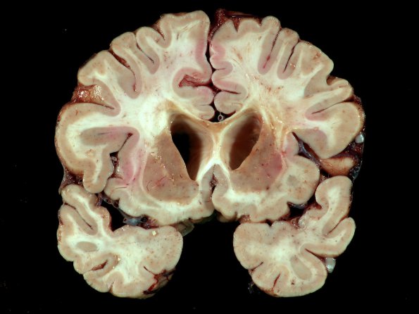 4E6 Cerebroretinal Vasculopathy, CRV, RVCL, TREX, HERNS, Case 4)_10