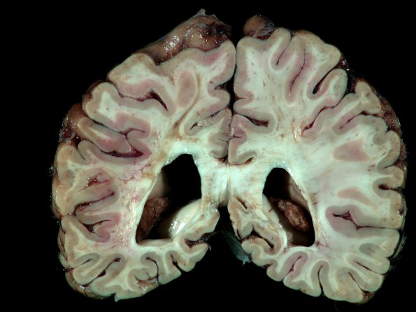 4E9 Cerebroretinal Vasculopathy, CRV, RVCL, TREX, HERNS, Case 4)_14