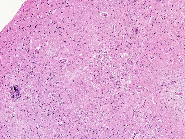 4F1 1Cerebroretinal vasculopathy, CRV, RVCL, TREX, HERNS, Case 4 ) N1 H&E 2