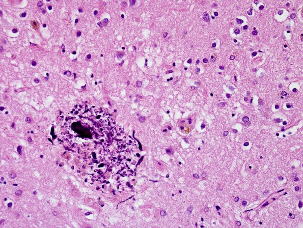 4F2 Cerebroretinal vasculopathy, CRV, RVCL, TREX, HERNS, Case 4) N1 H&E 