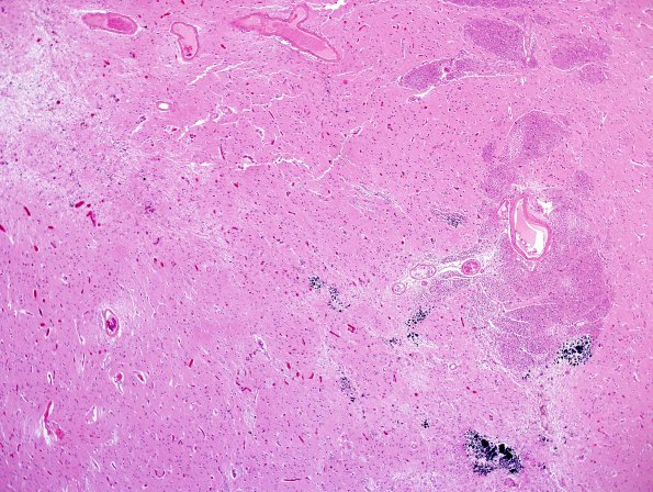 4G2 Cerebroretinal vasculopathy, CRV, RVCL, TREX, HERNS, Case 4) N2 H&E 4