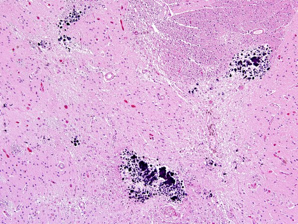 4G3 Cerebroretinal vasculopathy, CRV, RVCL, TREX, HERNS, Case 4) N2 H&E 1