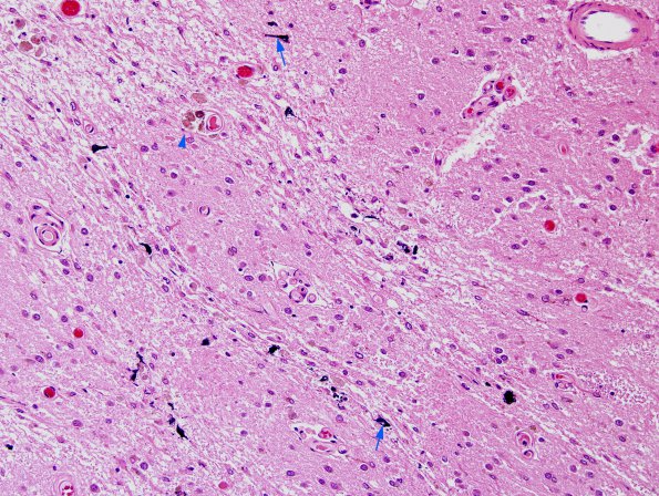 4G4 Cerebroretinal vasculopathy, CRV, RVCL, TREX, HERNS, Case 4) N2 H&E 3 copy