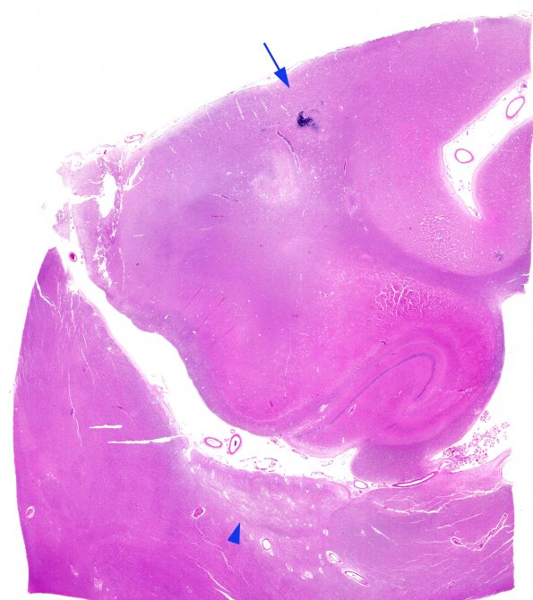 4H1 Cerebroretinal vasculopathy, CRV, RVCL, TREX, HERNS, Case 4) LGN N3 H&E whole mount copy