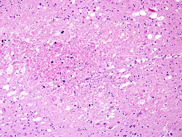 4H2 Cerebroretinal vasculopathy, CRV, RVCL, TREX, HERNS, Case 4) N3 H&E 1 (2)