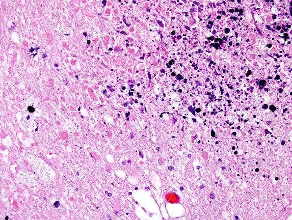 4H3 Cerebroretinal vasculopathy, CRV, RVCL, TREX, HERNS, Case 4) N3 H&E 1