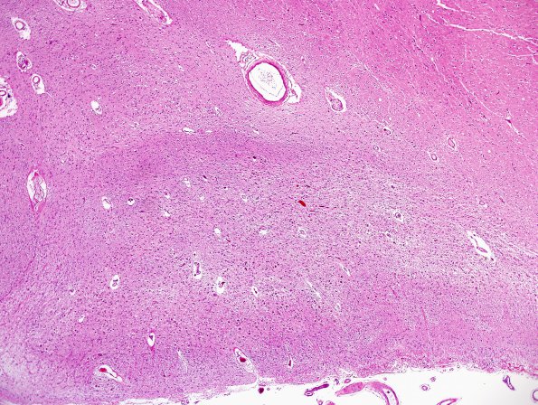 4H4 Cerebroretinal vasculopathy, CRV, RVCL, TREX, HERNS, Case 4) LGN N3 H&E LGN