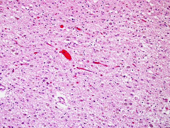 4H5 Cerebroretinal vasculopathy, CRV, RVCL, TREX, HERNS, Case 4) N3 H&E LGN 1