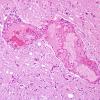 4I Cerebroretinal vasculopathy, CRV, RVCL, TREX, HERNS, Case 4) N4 H&E 1