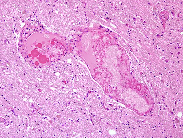 4I Cerebroretinal vasculopathy, CRV, RVCL, TREX, HERNS, Case 4) N4 H&E 1