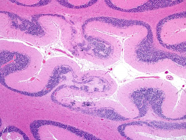 4K1 Cerebroretinal vasculopathy, CRV, RVCL, TREX, HERNS, Case 4) N9 H&E 3