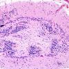 4K2 Cerebroretinal vasculopathy, CRV, RVCL, TREX, HERNS, Case 4) N9 H&E 4